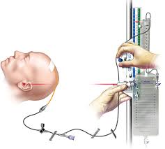 Care and management of external CSF drainage